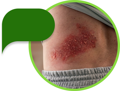 Image of shingles rash on back